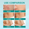 Before and after comparison of South Moon Medical Grade Scar Spray results on acne scars, surgical scars, and stretch marks – visible improvement in skin texture.