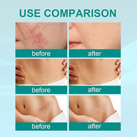 Before and after comparison of South Moon Medical Grade Scar Spray results on acne scars, surgical scars, and stretch marks – visible improvement in skin texture.