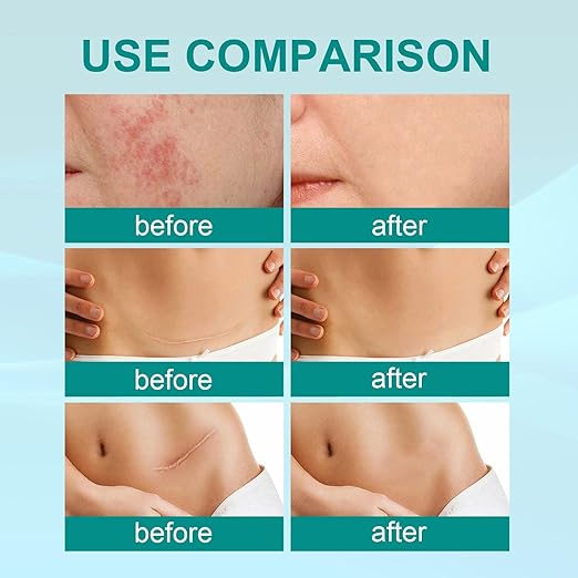 Before and after comparison of South Moon Medical Grade Scar Spray results on acne scars, surgical scars, and stretch marks – visible improvement in skin texture.
